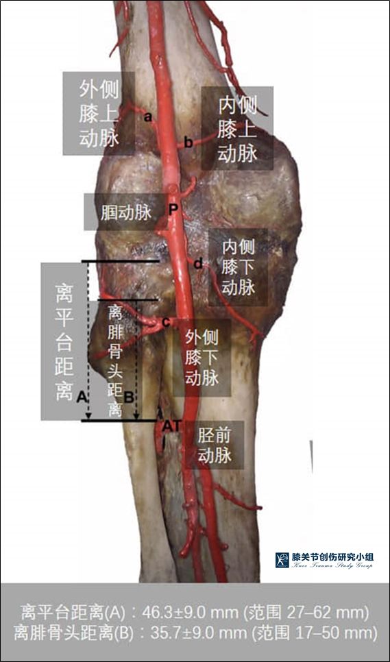 再者则来自于直接后外侧入路稍远处的胫前动脉分叉,nima heidari 2013
