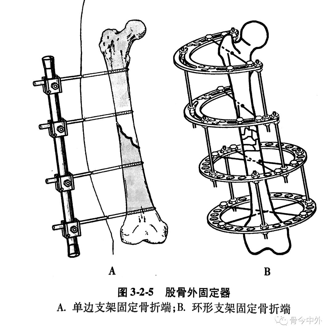『8分钟创伤』胫骨干骨折：Ilizarov外固定架的应用及手术技巧 - 上海开为医药科技有限公司--创伤、肢体矫形技术解决方案的专业服务商