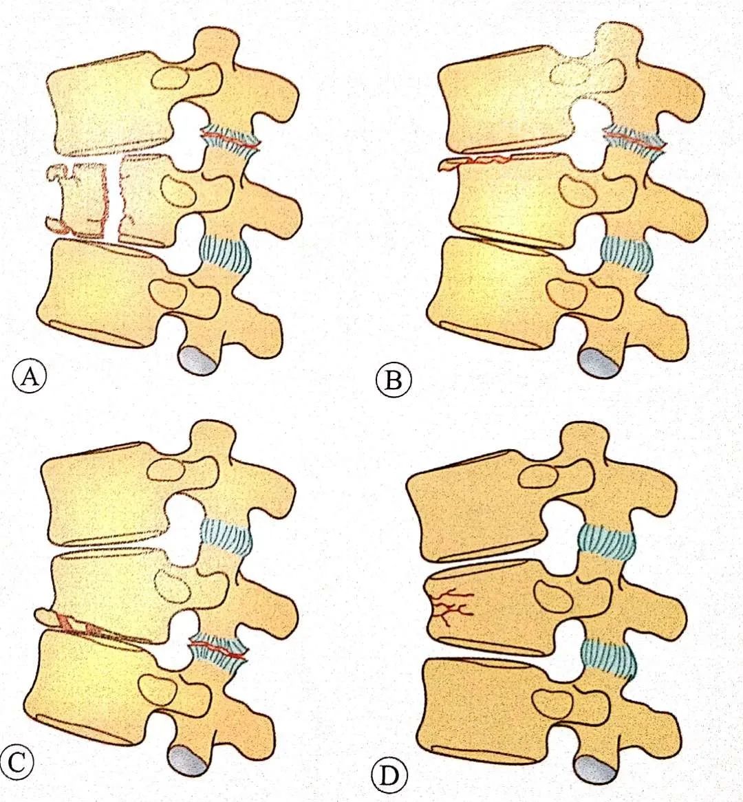 腰椎压缩骨折图片展示_腰椎压缩骨折相关图片下载