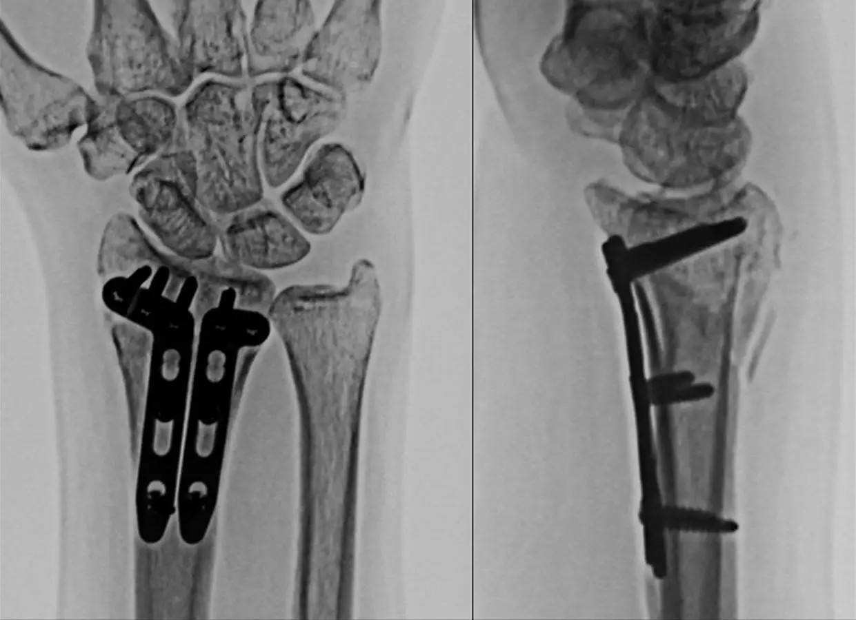 桡骨远端骨折手术图片,右手桡骨远端骨折图片 - 伤感说说吧