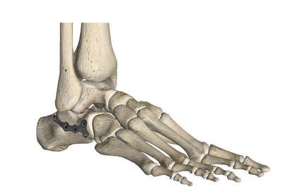 解剖型金屬接骨板-跟骨接骨板（跟骨鎖定板）