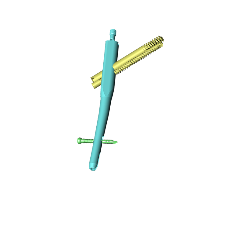 Proximal Femoral Interlocking Nails  -2.png