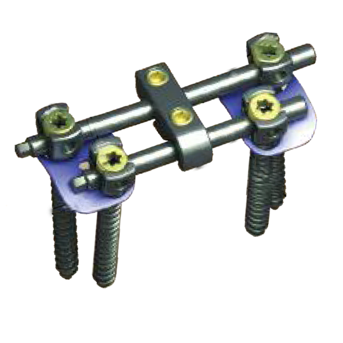 Anterior Thoracolumber Screw-Rod System.png