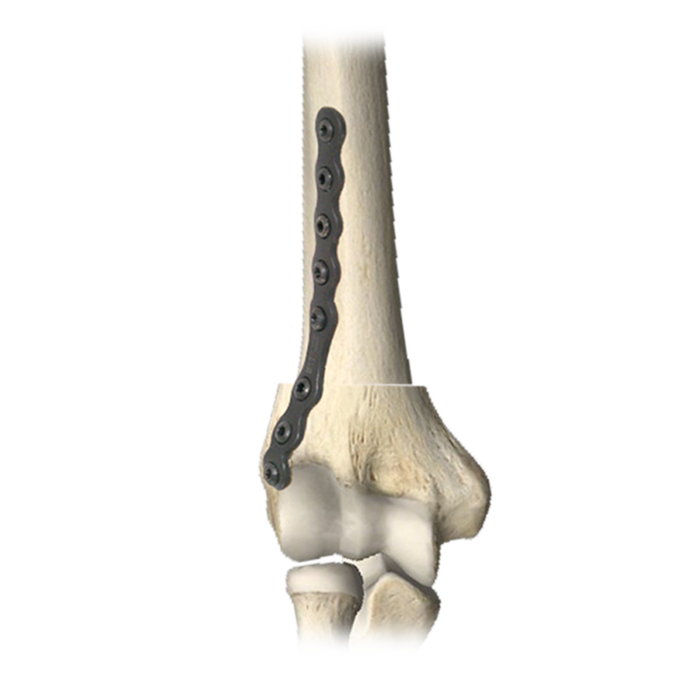 Distal Humeral Plate.png