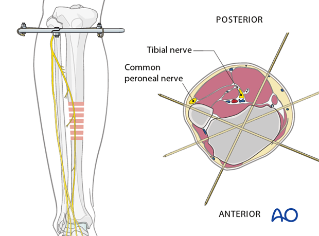 Proximal ring placement