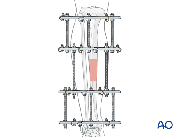 Reduction and final fixation