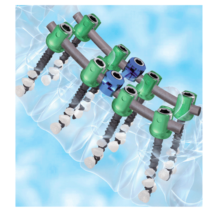 脊柱內(nèi)固定器I型Posterior Thoracolumber Screw-Rod   System.png