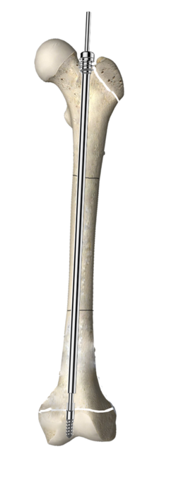 可延長髓內(nèi)針渲染圖-骨頭.png