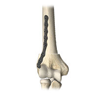 CareFix pediatric orthopedic Distal Humeral Plate
