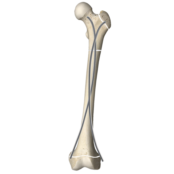 彈心髓內(nèi)釘Elastic Intramedullary Pin.png