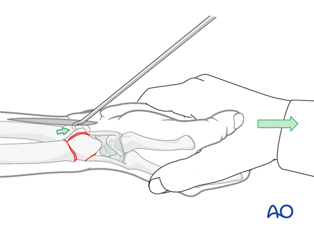orif palmar plate