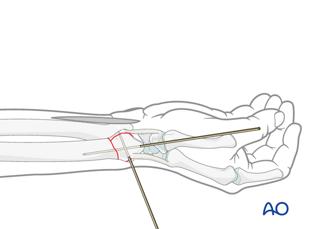 orif palmar plate