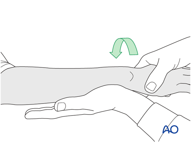 external fixation
