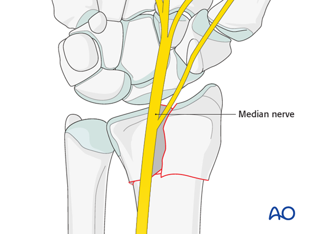 orif palmar plate