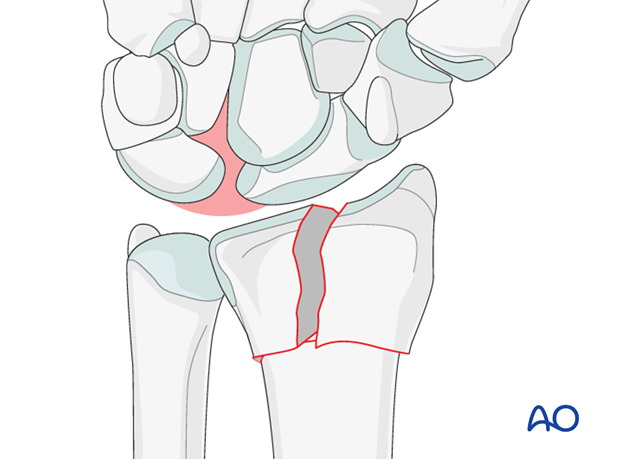 orif palmar plate