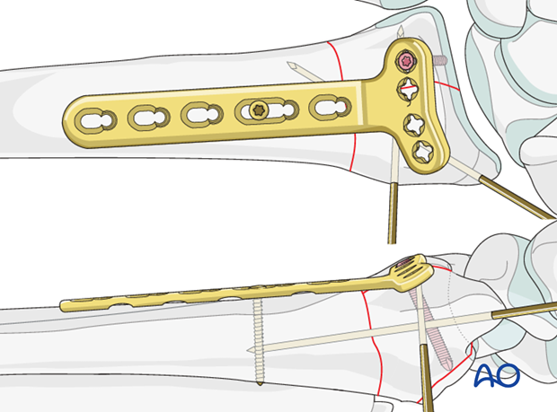 orif palmar plate
