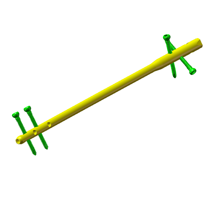 Tibial Interlocking Nails  png.png