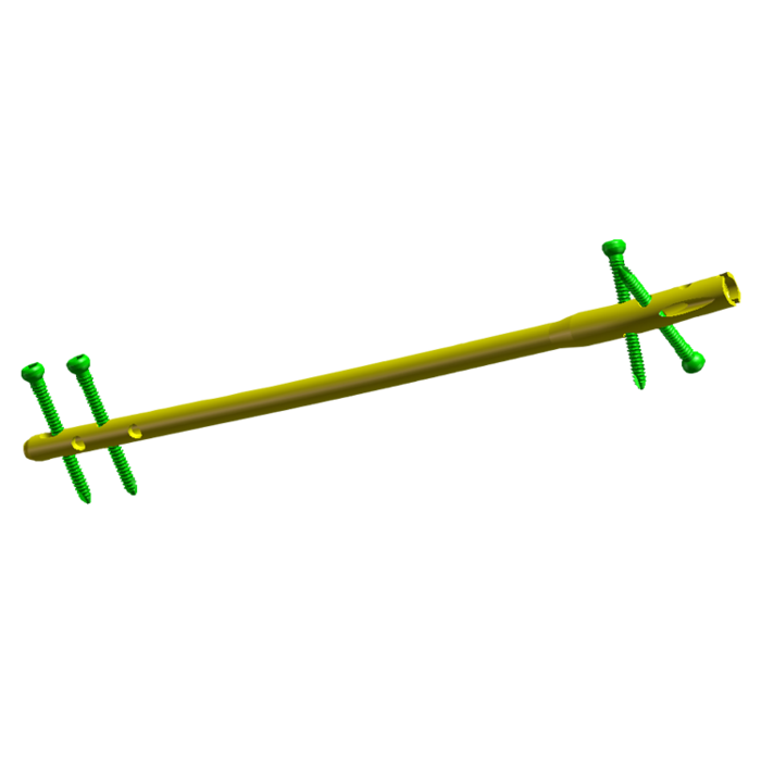 Tibial Interlocking Nails  1.png