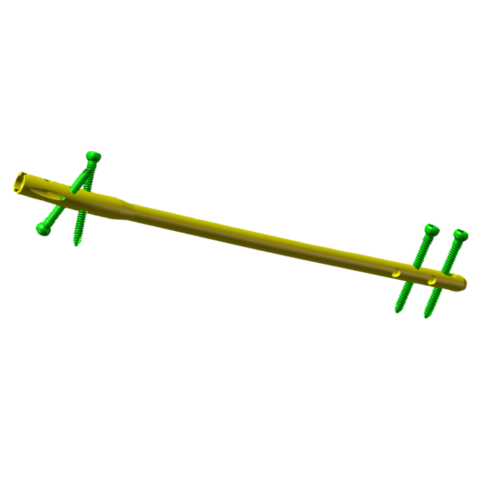 Tibial Interlocking Nails   -1.png