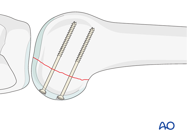 Completed osteosynthesis
