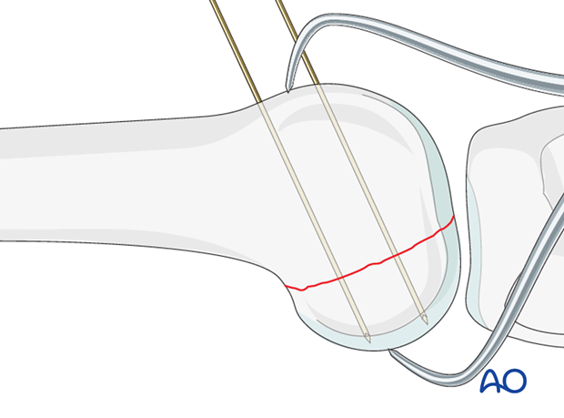 Control of guide wire placement