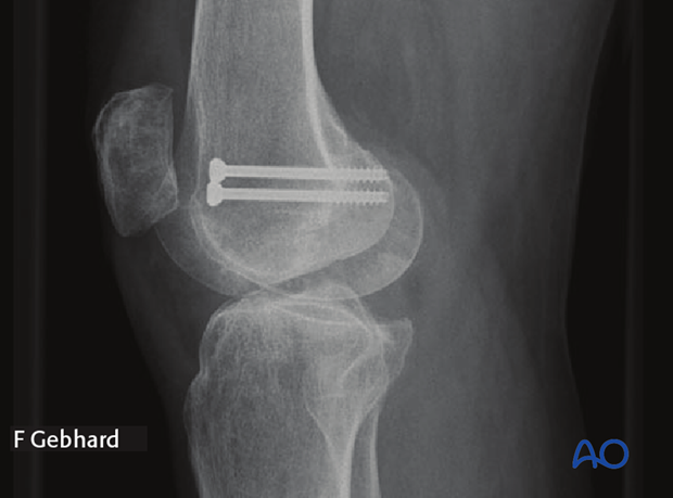 X-ray showing the completed osteosynthesis