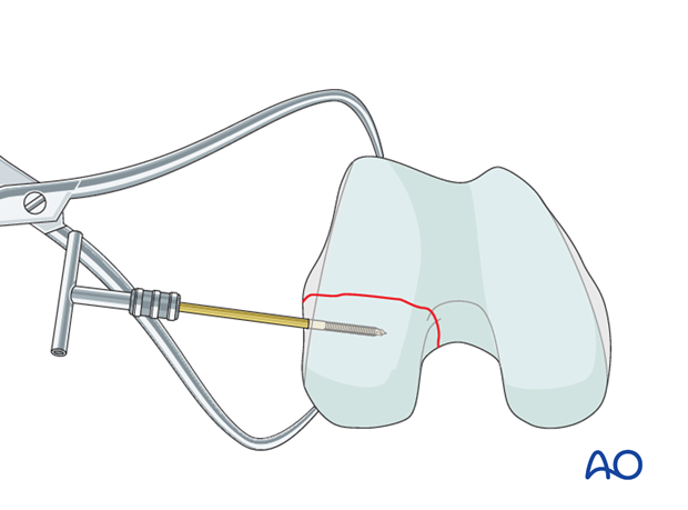 Reduction using reduction forceps