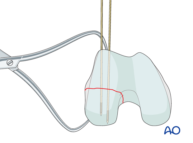 Guide wire insertion
