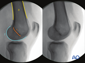 Intraoperative imaging of the knee