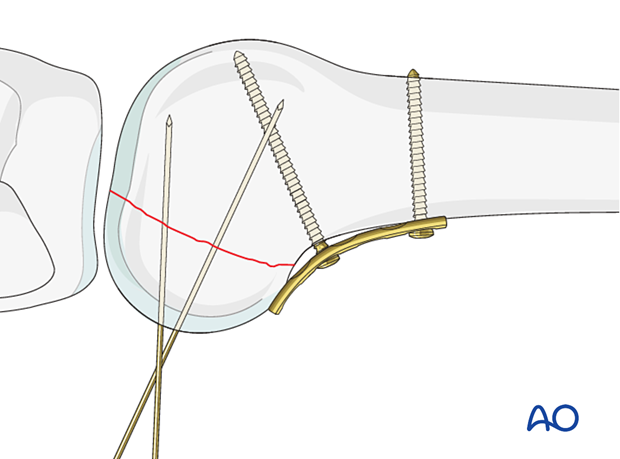 Plate fixation