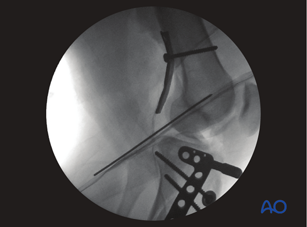 Intraoperative image