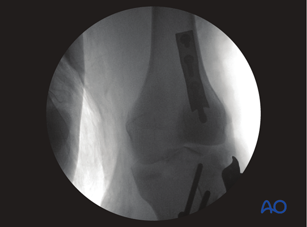 Postoperative image with posterior buttress plate in place.