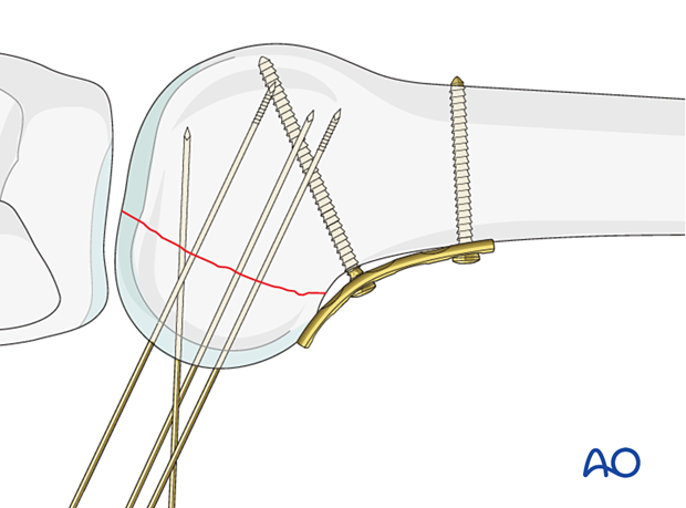 Guide-wire insertion