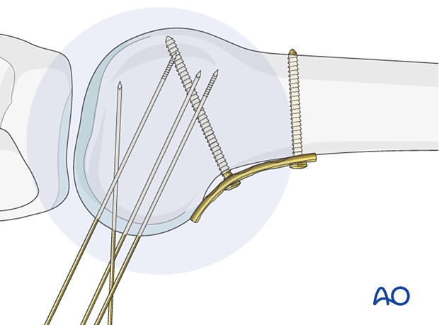 Control of guide-wire insertion