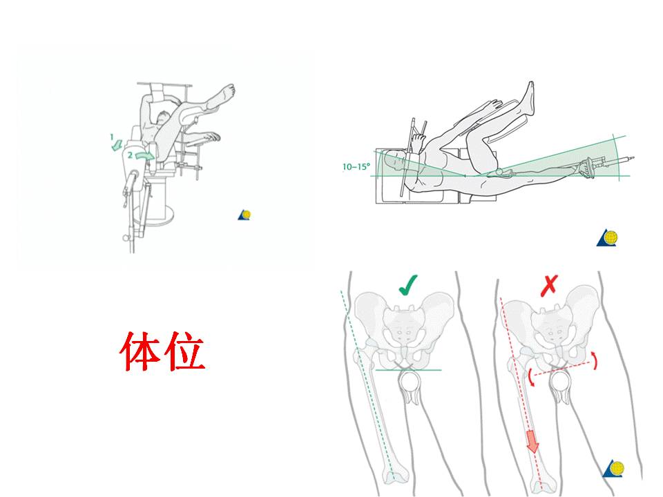 【手术技巧】pfn内固定治疗股骨粗隆间骨折 - 上海开为医药科技有限