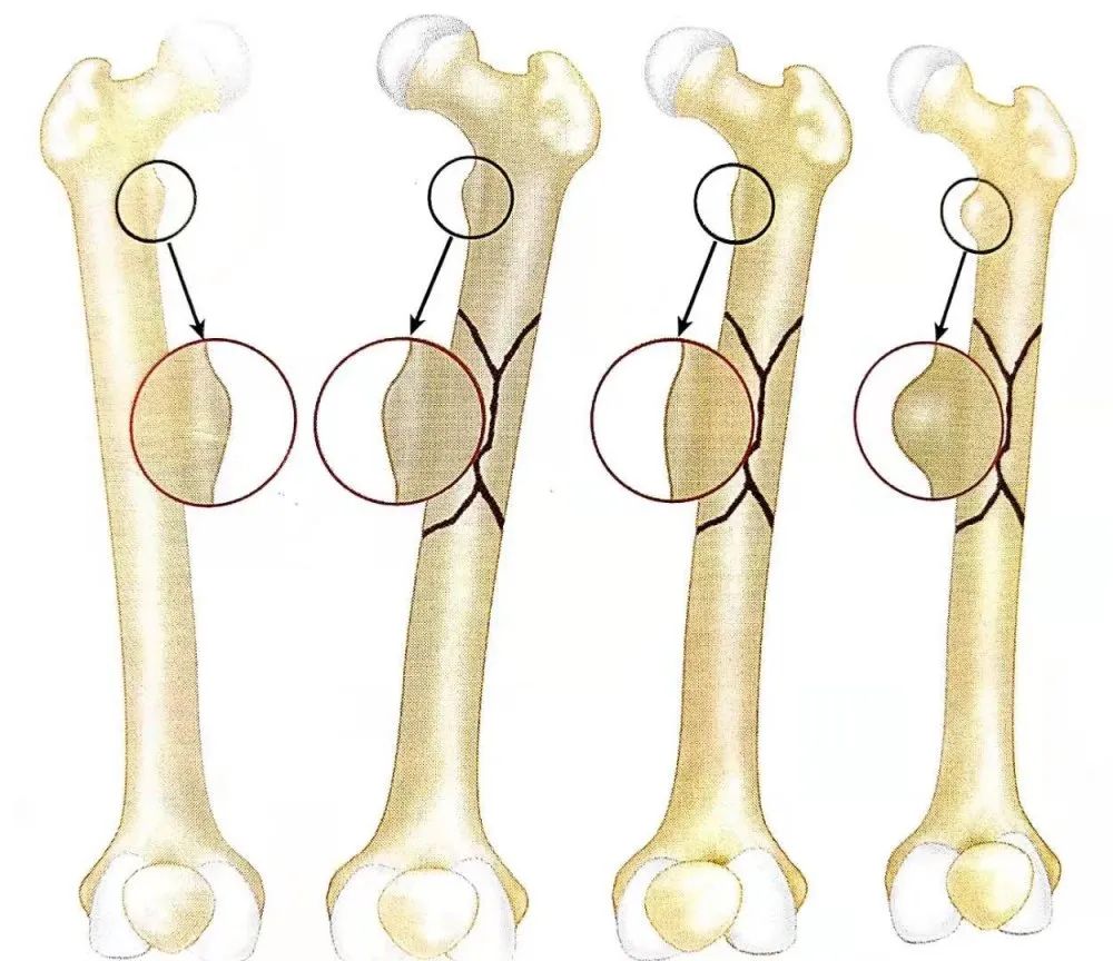 示意图4)纠正旋转移位,方法2:预先设定患侧股骨前倾的角度.