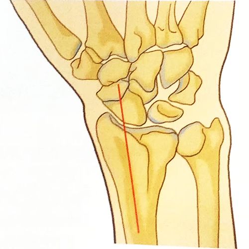 『8分钟创伤』桡骨远端骨折背侧入路切开复位内固定 - 上海开为医药