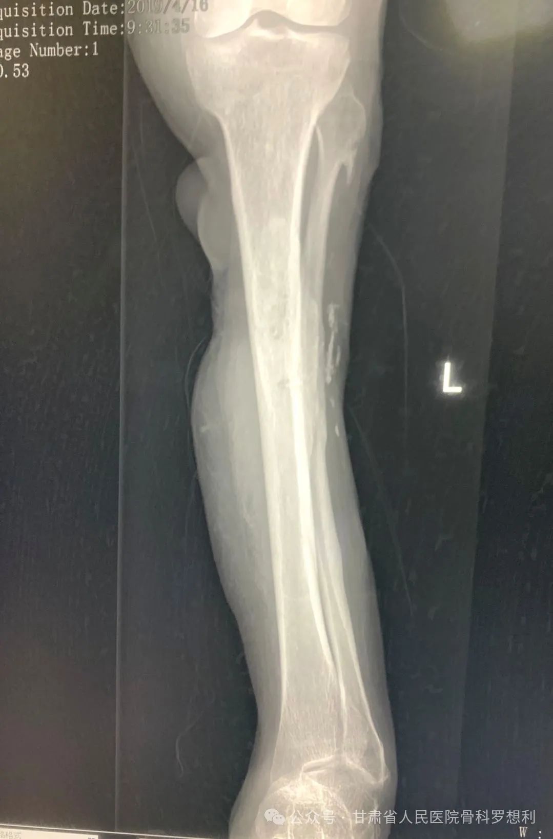 Ilizarov 技术治疗感染性胫骨缺损伴垂足畸形 - 上海开为医药科技有限公司--创伤、肢体矫形技术解决方案的专业服务商