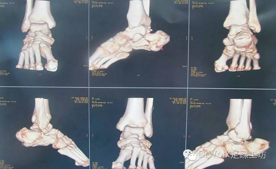 Sanders IV型跟骨骨折I 期是内固定还是融合？ - 上海开为医药科技有限公司--创伤、肢体矫形技术解决方案的专业服务商