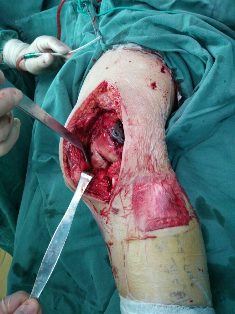 股骨远端骨折(髁间,髁上,hoffa骨折) - 上海开为医药科技有限公司