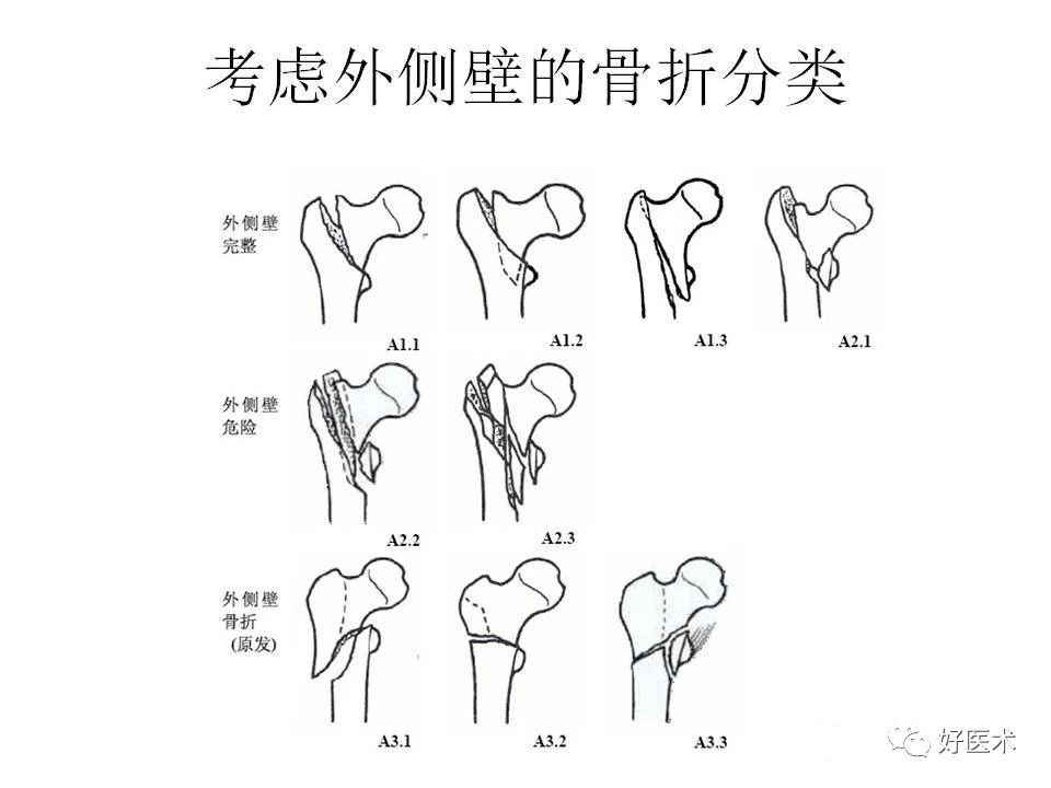 早读 | 股骨转子间骨折的分型及内固定选择