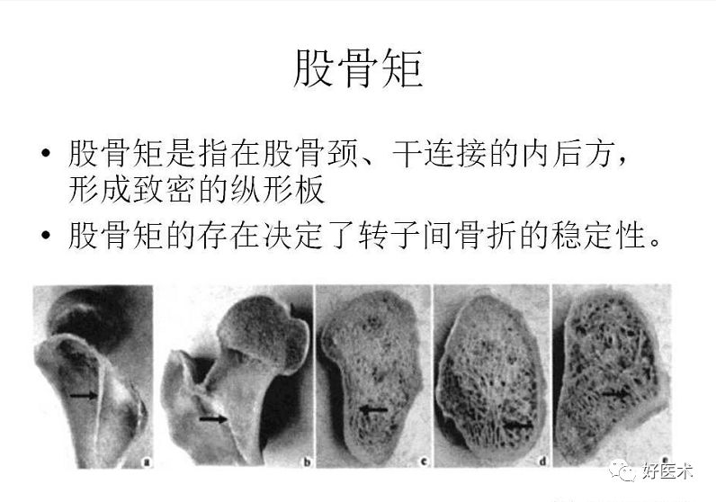 明显,疼痛亦较剧烈,都比股骨颈骨折严重;前者的压痛点多在大粗隆部