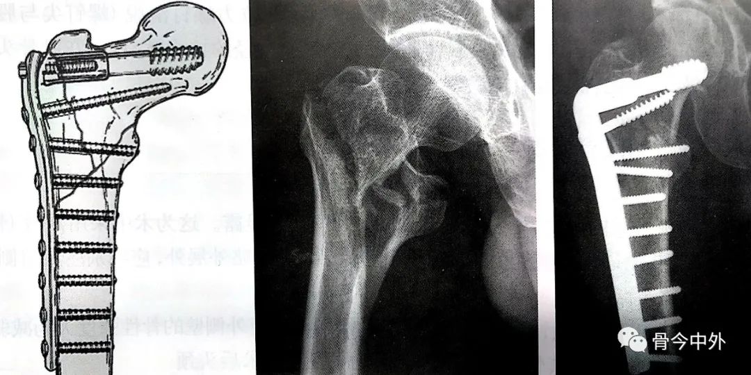 动力髁螺钉固定时滑动螺钉置入点较高,适用于股骨大粗隆骨质完整或大