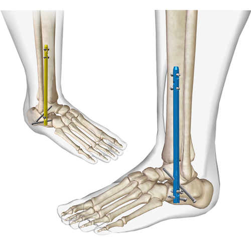 踝关节融合髓内钉