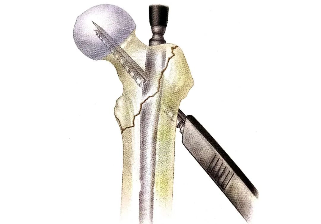 8分钟创伤股骨转子间骨折的髓内钉治疗intertan