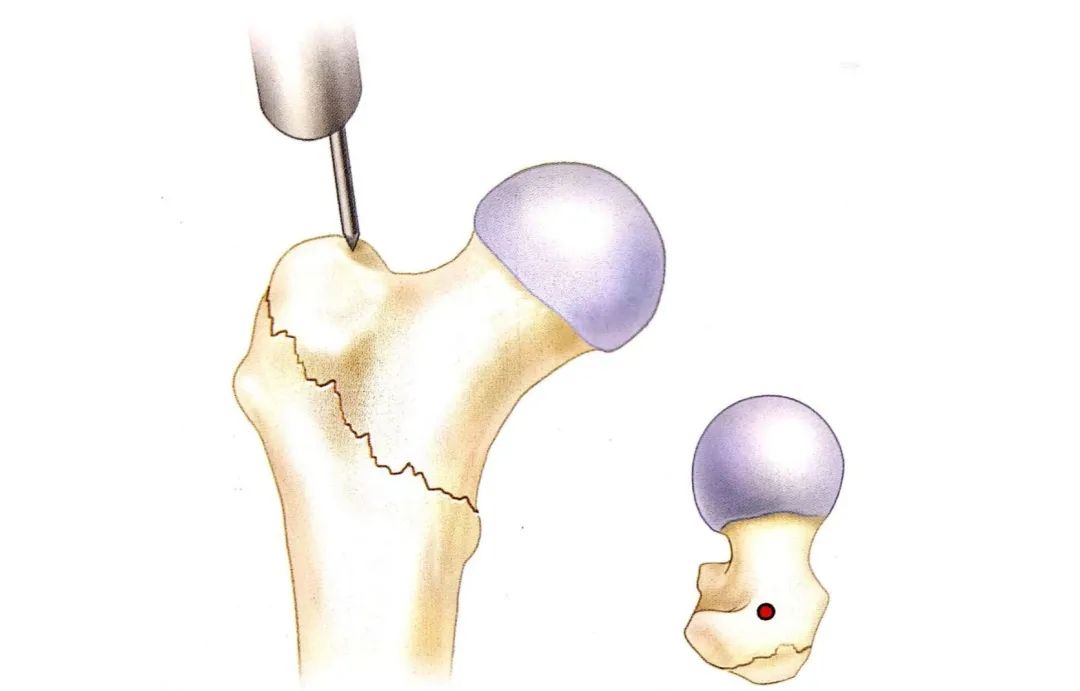 8分钟创伤股骨转子间骨折的髓内钉治疗intertan