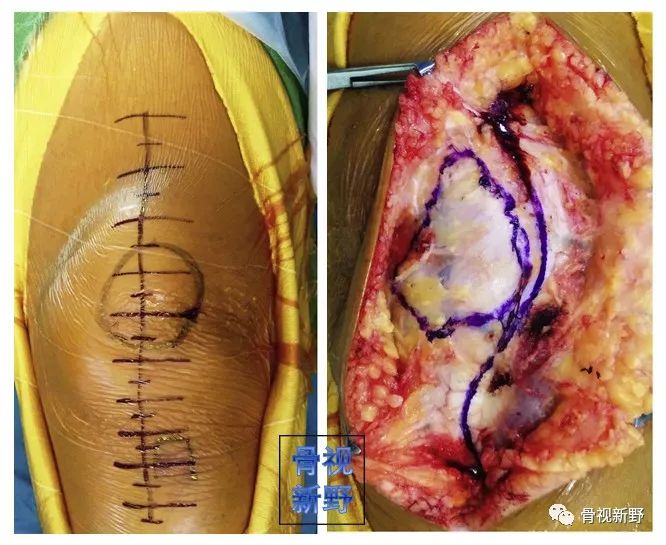 屈膝位向外推开伸膝装置可显露股骨内髁前,内侧大部分关节面.