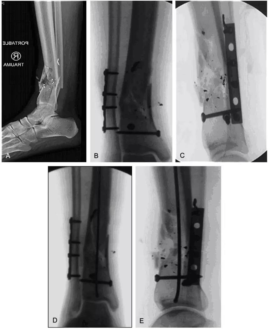 图2阻挡螺钉的使用图a显示胫骨远端干骺端高度粉碎性骨折后向后成角