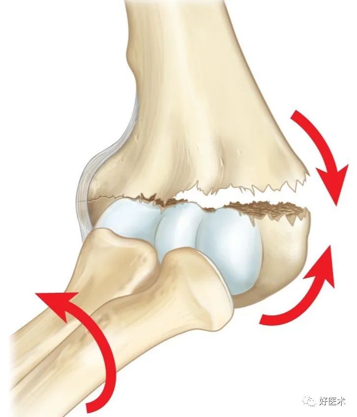 早读临床必备儿童肱骨髁上骨折复位方法及经皮穿针技巧详解