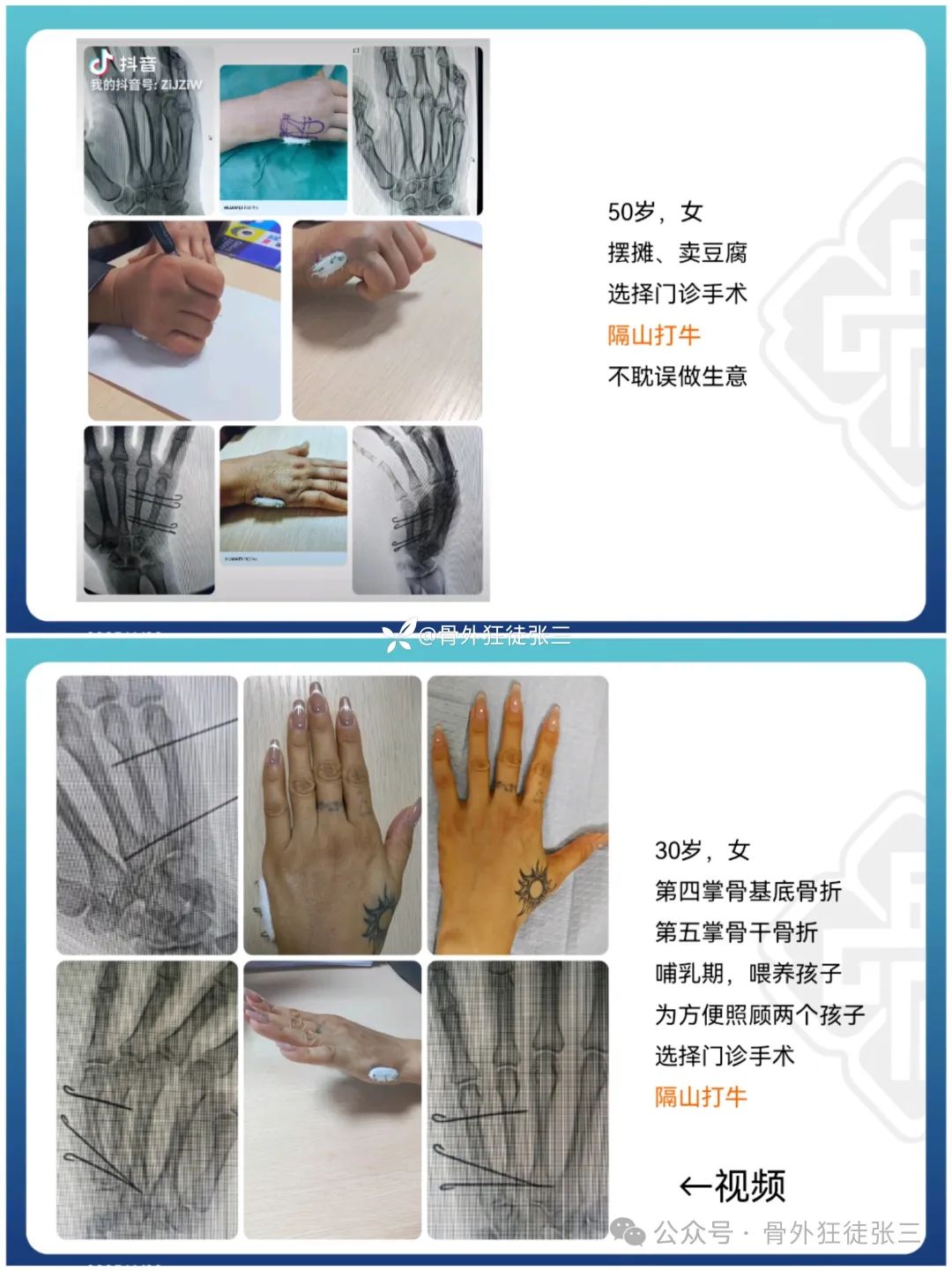 骨科精读 | 压箱作:“针”人“针”事之万能克氏针在创伤骨科的应用。 - 上海开为医药科技有限公司--创伤、肢体矫形技术解决方案的专业服务商
